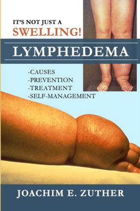 Its Not Just a Swelling Lymphedema