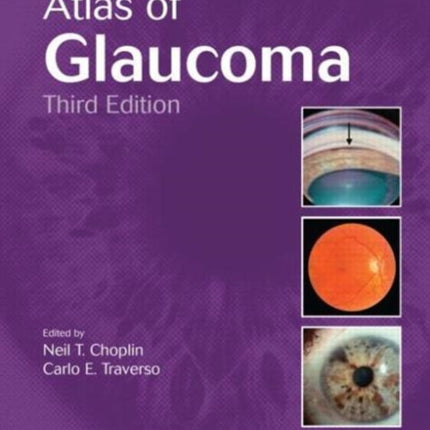 Atlas of Glaucoma