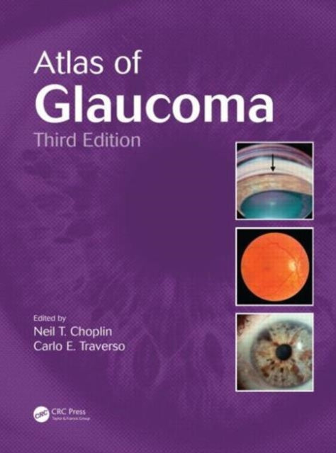 Atlas of Glaucoma