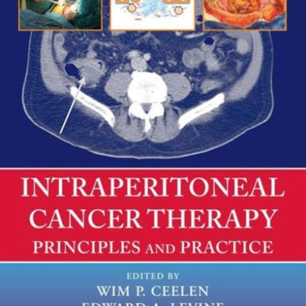 Intraperitoneal Cancer Therapy: Principles and Practice