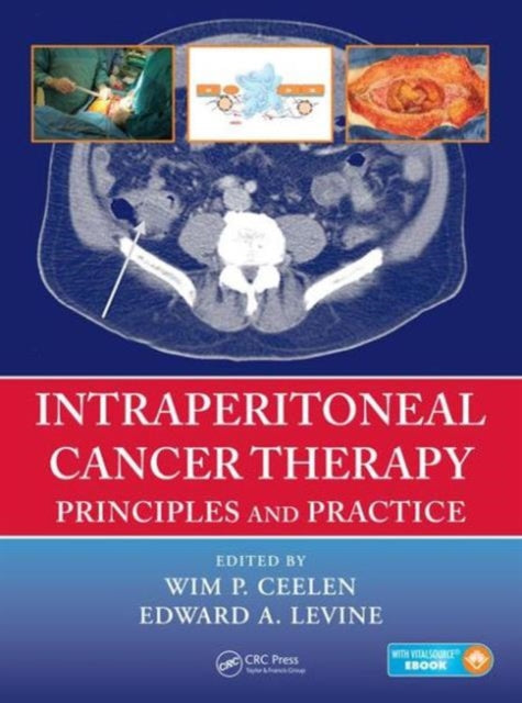 Intraperitoneal Cancer Therapy: Principles and Practice