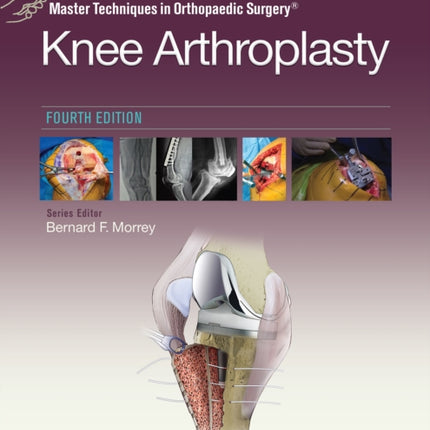 Master Techniques in Orthopedic Surgery Knee