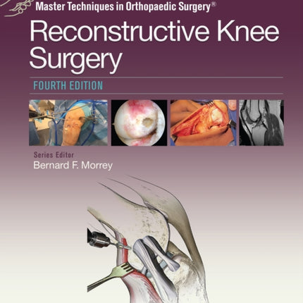 Master Techniques in Orthopaedic Surgery: Reconstructive Knee Surgery