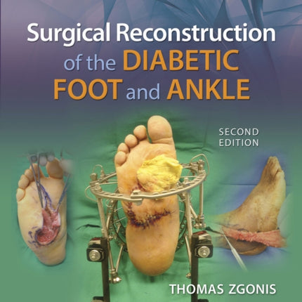 Surgical Reconstruction of the Diabetic Foot and Ankle