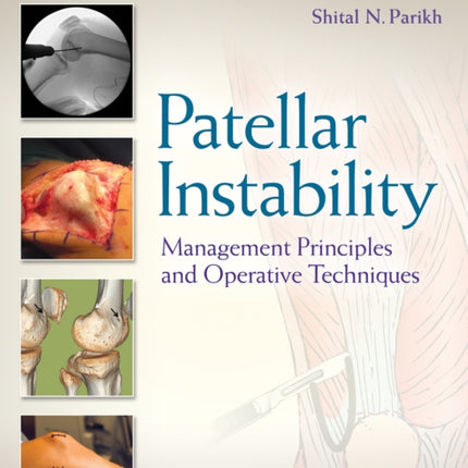 Patellar Instability: Management Principles and Operative Techniques