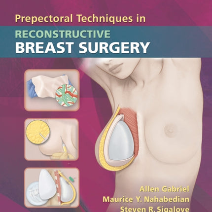 Prepectoral Techniques in Reconstructive Breast Surgery