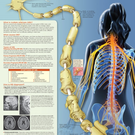 Understanding Multiple Sclerosis Anatomical Chart