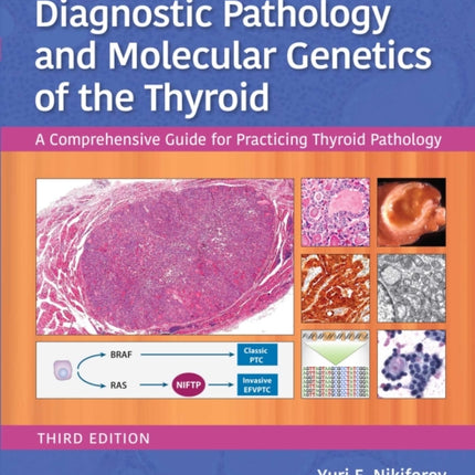 Diagnostic Pathology and Molecular Genetics of the Thyroid: A Comprehensive Guide for Practicing Thyroid Pathology