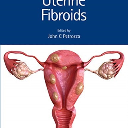 Uterine Fibroids