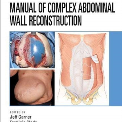 Manual of Complex Abdominal Wall Reconstruction