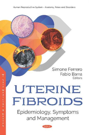 Uterine Fibroids: Epidemiology, Symptoms and Management