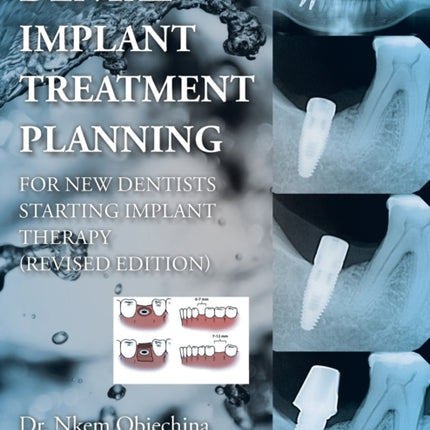 Dental Implant Treatment Planning for New Dentists Starting Implant Therapy