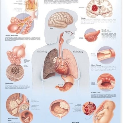 Dangers of Smoking Anatomical Chart