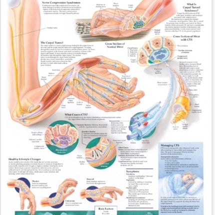 Understanding Carpal Tunnel Syndrome Anatomical Chart