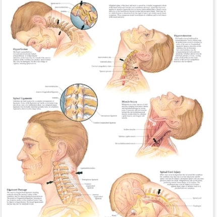 Whiplash Injuries of the Head and Neck Anatomical