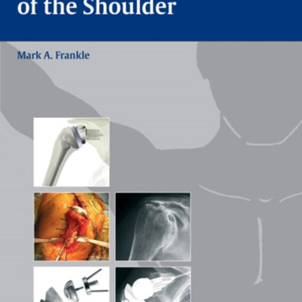 Rotator Cuff Deficiency of the Shoulder