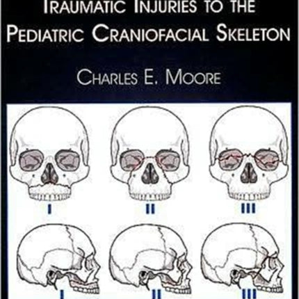 Diagnosis and Treatment of Traumatic Injuries to the Pediatric Craniofacial Skeleton