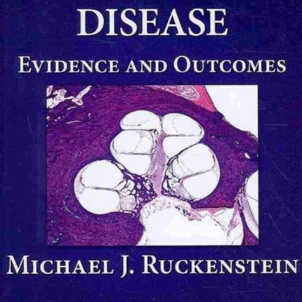 Meniere's Disease: Evidence and Outcomes