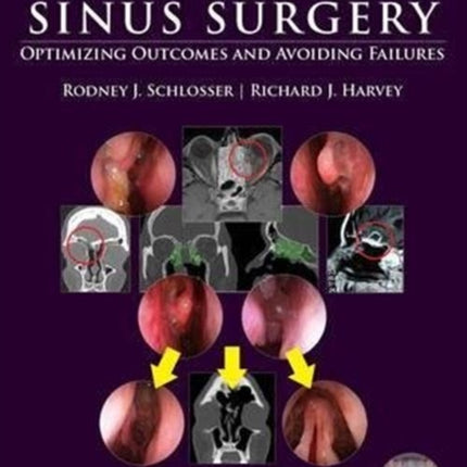 Endoscopic Sinus Surgery