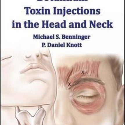 Techniques of Botulinum Toxin Injections in the Head and Neck