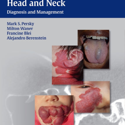 Vascular Lesions of the Head and Neck: Diagnosis and Management
