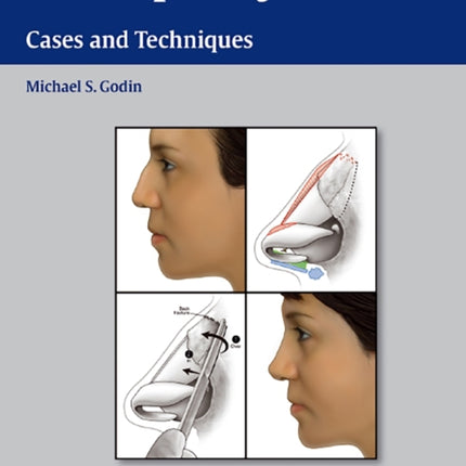 Rhinoplasty: Cases and Techniques