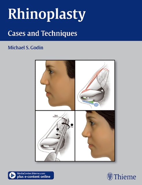 Rhinoplasty: Cases and Techniques