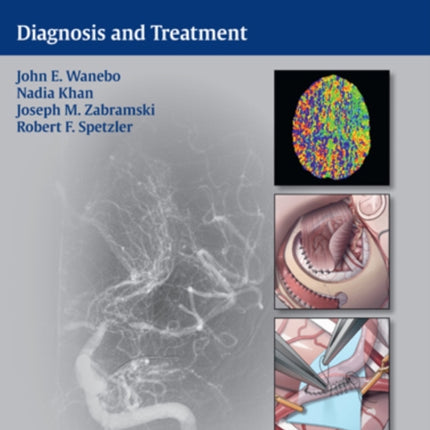 Moyamoya Disease: Diagnosis and Treatment