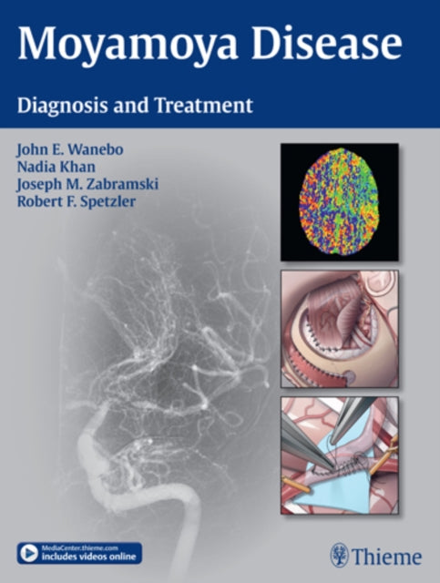 Moyamoya Disease: Diagnosis and Treatment