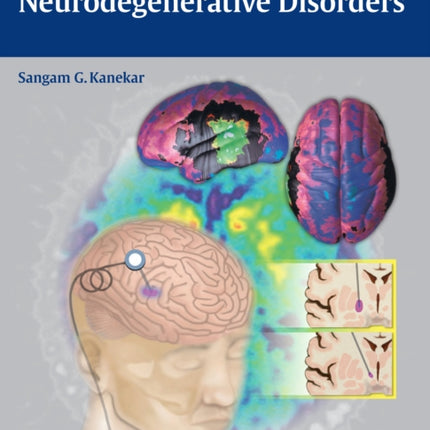 Imaging of Neurodegenerative Disorders