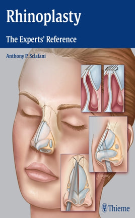 Rhinoplasty: The Experts' Reference