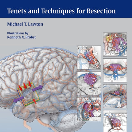 Seven AVMs: Tenets and Techniques for Resection