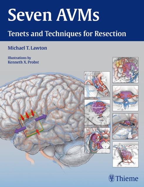 Seven AVMs: Tenets and Techniques for Resection