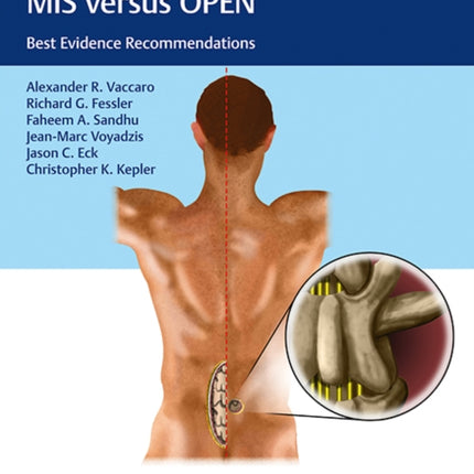 Controversies in Spine Surgery, MIS versus OPEN: Best Evidence Recommendations