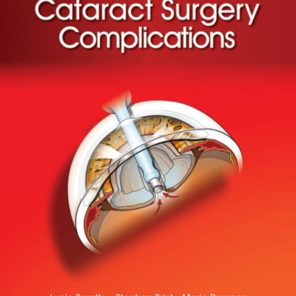 Cataract Surgery Complications