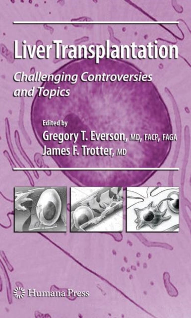 Liver Transplantation: Challenging Controversies and Topics