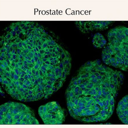 Prostate Cancer