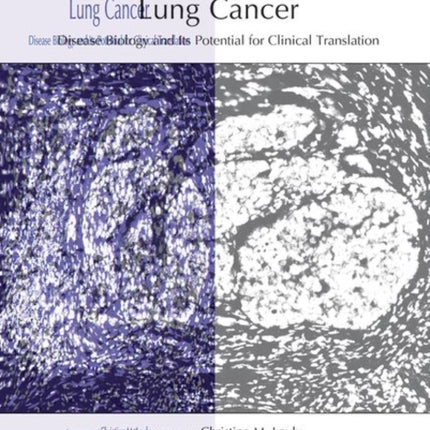 Lung Cancer: Disease Biology and Its Potential for Clinical Translation