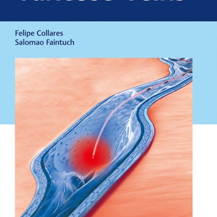 Varicose Veins: Practical Guides in Interventional Radiology