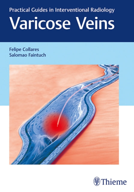 Varicose Veins: Practical Guides in Interventional Radiology