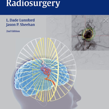 Intracranial Stereotactic Radiosurgery