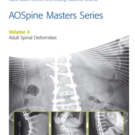 AOSpine Master Series, Vol. 4: Adult Spinal Deformities