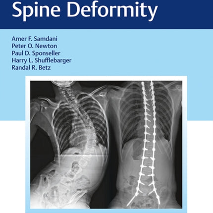 Neuromuscular Spine Deformity