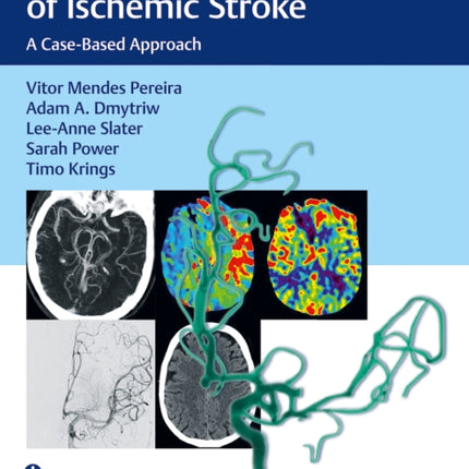 Endovascular Management of Ischemic Stroke