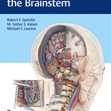 Surgery of the Brainstem