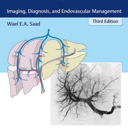 Portal Hypertension: Imaging, Diagnosis, and Endovascular Management