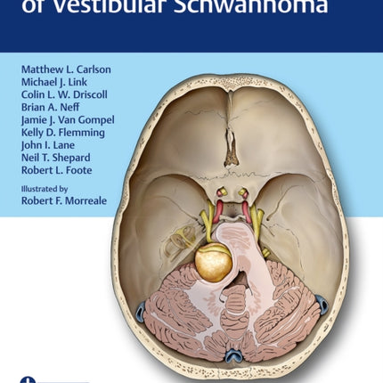 Comprehensive Management of Vestibular Schwannoma