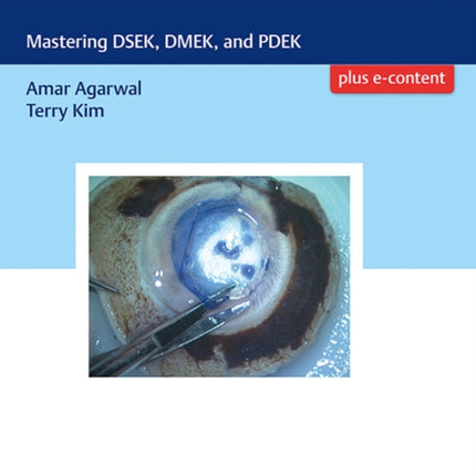 Endothelial Keratoplasty: Mastering DSEK, DMEK, and PDEK