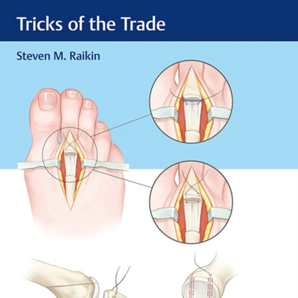 Foot and Ankle Surgery: Tricks of the Trade