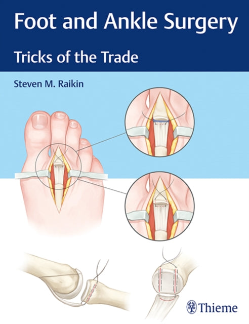 Foot and Ankle Surgery: Tricks of the Trade